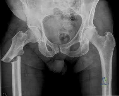 Illustration 248 for OrthoCash: Trauma MCQs & Cases for a yearold woman