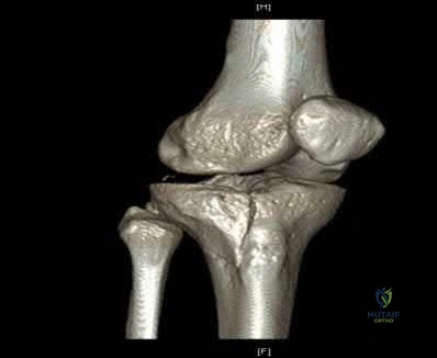 Illustration 253 for OrthoCash: Trauma MCQs & Cases for a yearold woman