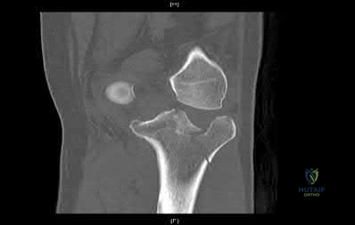 Illustration 254 for OrthoCash: Trauma MCQs & Cases for a yearold woman