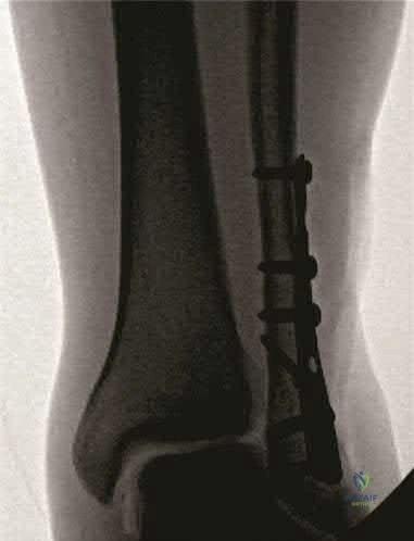 Illustration 257 for OrthoCash: Trauma MCQs & Cases for a yearold woman
