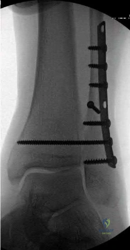 Illustration 258 for OrthoCash: Trauma MCQs & Cases for a yearold woman