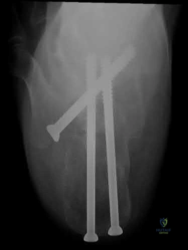 Illustration 262 for OrthoCash: Trauma MCQs & Cases for a yearold woman