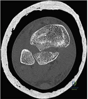 Illustration 270 for OrthoCash: Trauma MCQs & Cases for a yearold woman