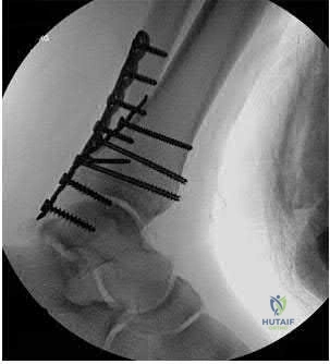 Illustration 271 for OrthoCash: Trauma MCQs & Cases for a yearold woman