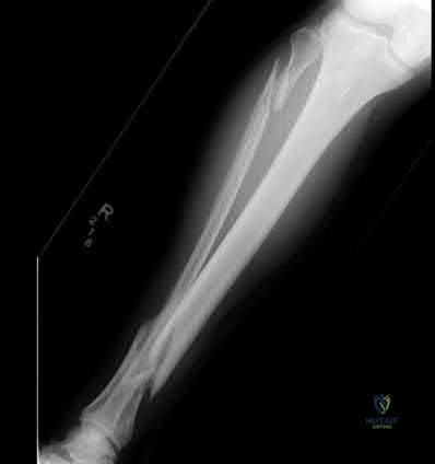 Illustration 274 for OrthoCash: Trauma MCQs & Cases for a yearold woman