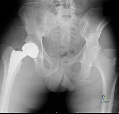 Illustration 287 for OrthoCash: Trauma MCQs & Cases for a yearold woman