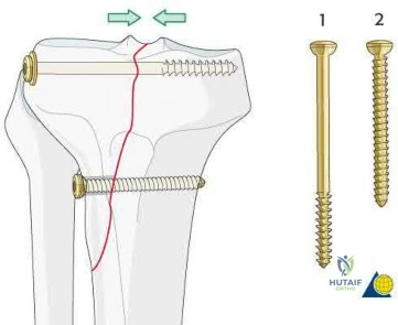 Illustration 296 for OrthoCash: Trauma MCQs & Cases for a yearold woman