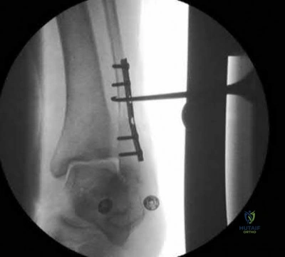 Illustration 297 for OrthoCash: Trauma MCQs & Cases for a yearold woman