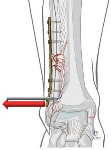 Illustration 298 for OrthoCash: Trauma MCQs & Cases for a yearold woman