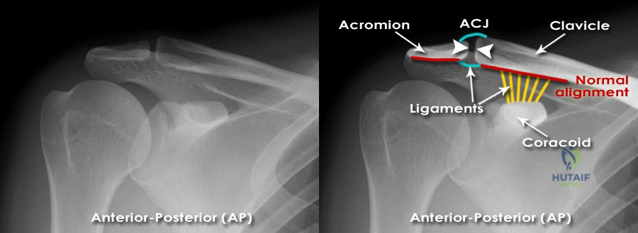Illustration 3 for Acromioclavicular Dislocation: Your Guide to AC Joint Care