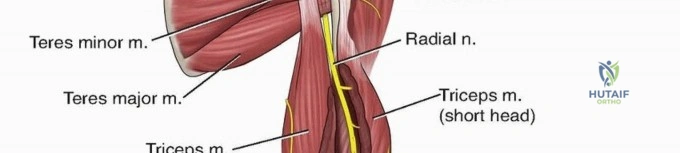 Illustration 3 for Enhance Recovery: Humeral Plate Fixation for Brachialis & Brachioradialis