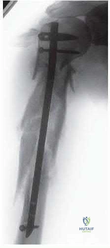 Illustration 301 for OrthoCash: Trauma MCQs & Cases for a yearold woman