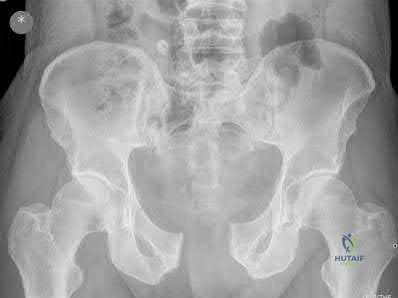 Illustration 303 for OrthoCash: Trauma MCQs & Cases for a yearold woman