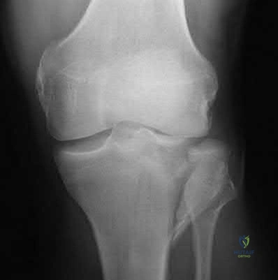 Illustration 304 for OrthoCash: Trauma MCQs & Cases for a yearold woman