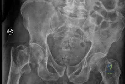 Illustration 306 for OrthoCash: Trauma MCQs & Cases for a yearold woman