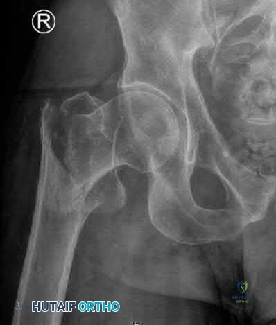 Illustration 307 for OrthoCash: Trauma MCQs & Cases for a yearold woman
