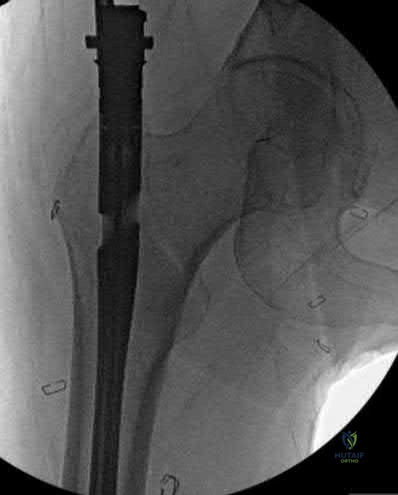 Illustration 308 for OrthoCash: Trauma MCQs & Cases for a yearold woman
