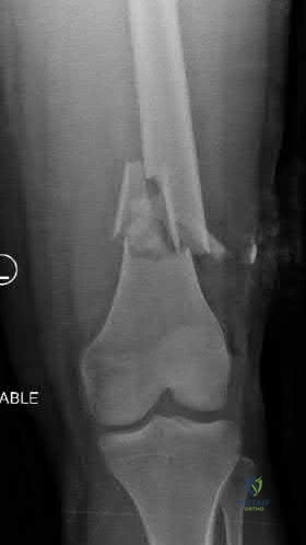 Illustration 311 for OrthoCash: Trauma MCQs & Cases for a yearold woman