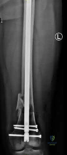 Illustration 314 for OrthoCash: Trauma MCQs & Cases for a yearold woman