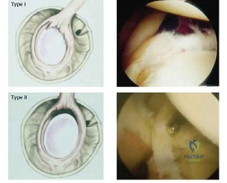 صورة توضيحية لـ تمزق الشفا الحقاني العلوي (SLAP Tear): دليلك الشامل للتشخيص والعلاج في صنعاء مع الأستاذ الدكتور محمد هطيف