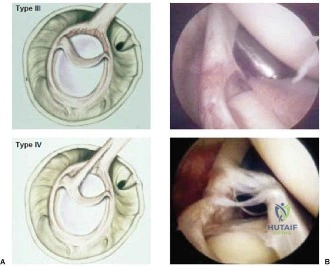 صورة توضيحية لـ تمزق الشفا الحقاني العلوي (SLAP Tear): دليلك الشامل للتشخيص والعلاج في صنعاء مع الأستاذ الدكتور محمد هطيف