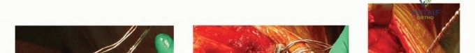 Smith-Petersen Approach: Comprehensive Surgical Anatomy, Indications, & Risks