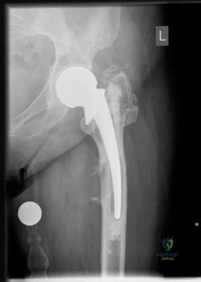 Illustration of structured hip oral - Dr. Mohammed Hutaif