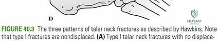Illustration of talus fractures talus - Dr. Mohammed Hutaif