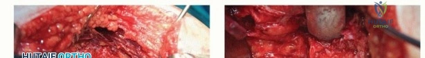 صورة طبية: تقنيات استبدال مفصل الورك الكلي (THA) المتخصصة لتشوهات الورك الشديدة: دليل شامل للمرضى مع الأستاذ الدكتور محمد هطيف