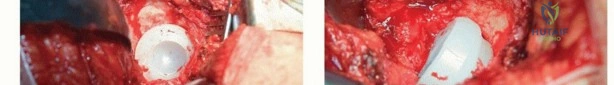 صورة طبية: تقنيات استبدال مفصل الورك الكلي (THA) المتخصصة لتشوهات الورك الشديدة: دليل شامل للمرضى مع الأستاذ الدكتور محمد هطيف