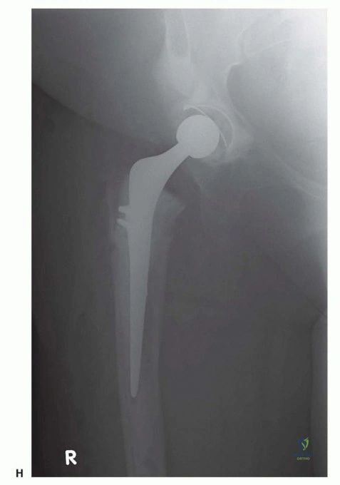 صورة طبية: تقنيات استبدال مفصل الورك الكلي (THA) المتخصصة لتشوهات الورك الشديدة: دليل شامل للمرضى مع الأستاذ الدكتور محمد هطيف