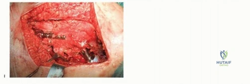 صورة طبية: تقنيات استبدال مفصل الورك الكلي (THA) المتخصصة لتشوهات الورك الشديدة: دليل شامل للمرضى مع الأستاذ الدكتور محمد هطيف