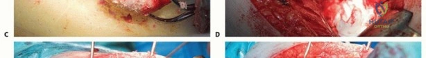 صورة طبية: تقنيات استبدال مفصل الورك الكلي (THA) المتخصصة لتشوهات الورك الشديدة: دليل شامل للمرضى مع الأستاذ الدكتور محمد هطيف