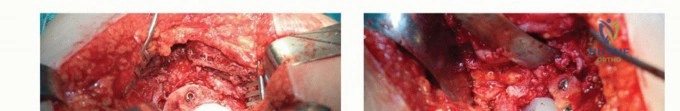 صورة طبية: تقنيات استبدال مفصل الورك الكلي (THA) المتخصصة لتشوهات الورك الشديدة: دليل شامل للمرضى مع الأستاذ الدكتور محمد هطيف