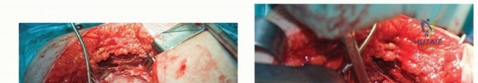 صورة طبية: تقنيات استبدال مفصل الورك الكلي (THA) المتخصصة لتشوهات الورك الشديدة: دليل شامل للمرضى مع الأستاذ الدكتور محمد هطيف
