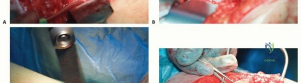 صورة طبية: تقنيات استبدال مفصل الورك الكلي (THA) المتخصصة لتشوهات الورك الشديدة: دليل شامل للمرضى مع الأستاذ الدكتور محمد هطيف