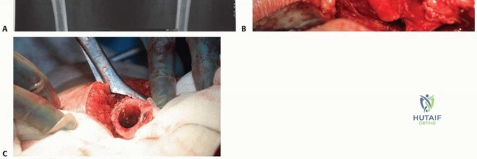 صورة طبية: تقنيات استبدال مفصل الورك الكلي (THA) المتخصصة لتشوهات الورك الشديدة: دليل شامل للمرضى مع الأستاذ الدكتور محمد هطيف