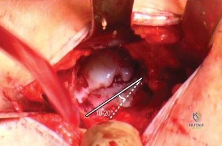 Illustration of nanos neck preserving - Dr. Mohammed Hutaif