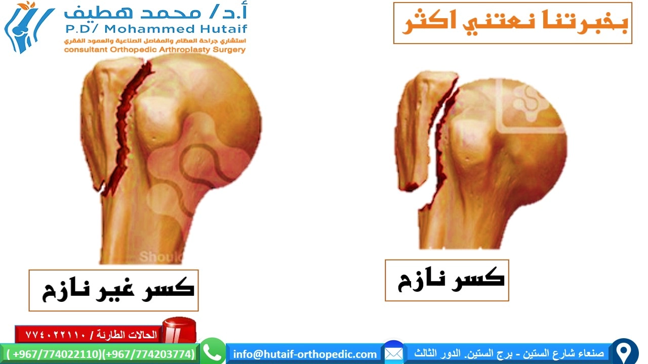 كسور الحدبة الكبرى- كسور راس عظم العضد القريبة=كسر الحدبة الكبيرة من غير إزاحة