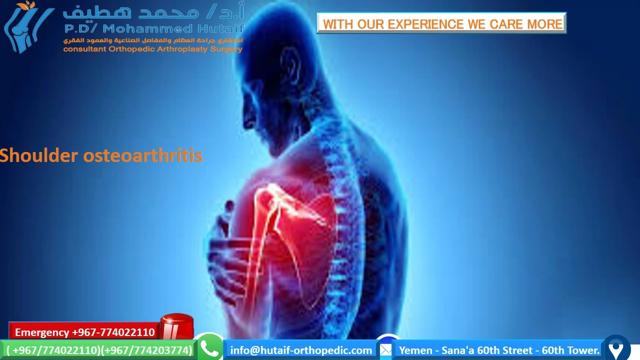 Shoulder Osteoarthritis Symptoms: Know the Signs in Your Shoulder