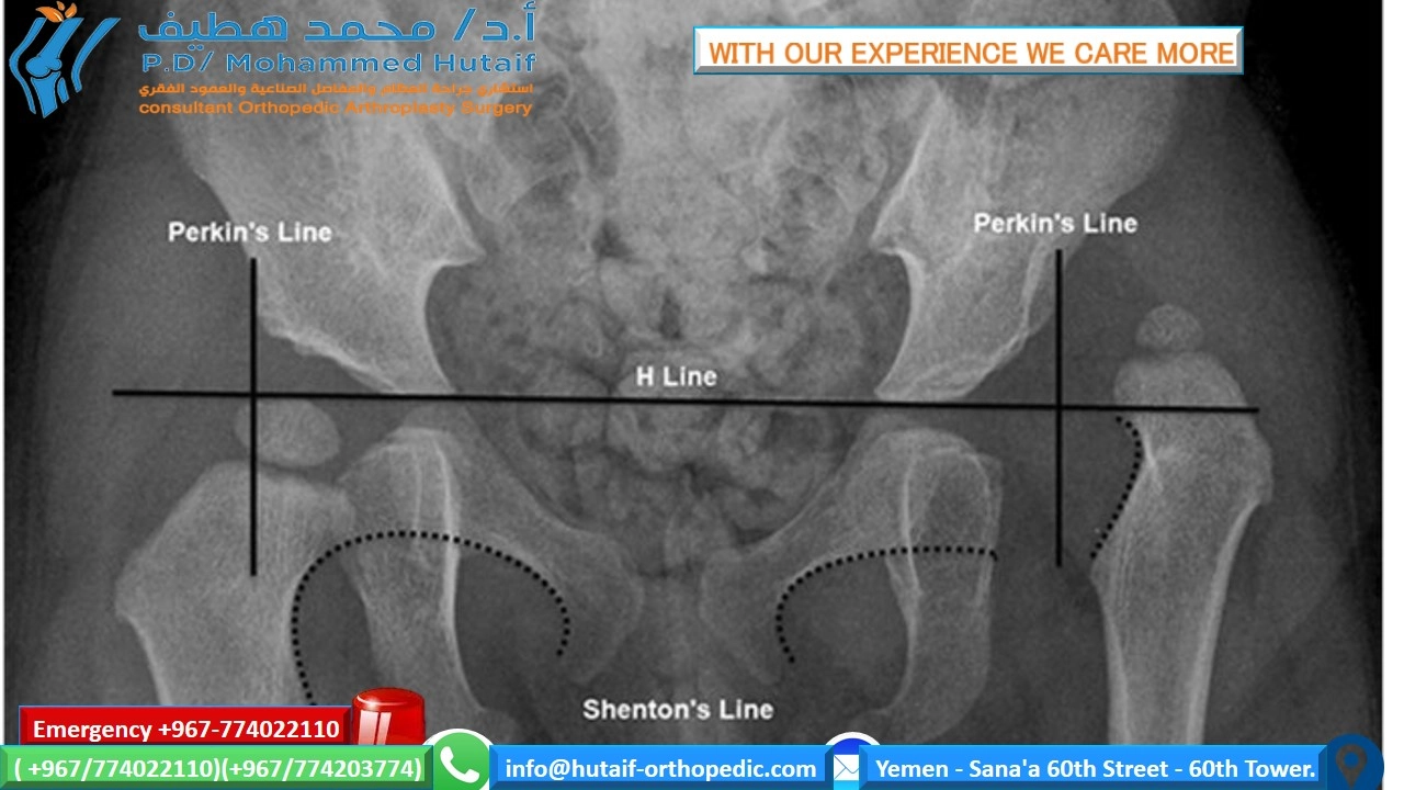 Mastering Hip DysplasiaImaging & Other Diagnostic Methods