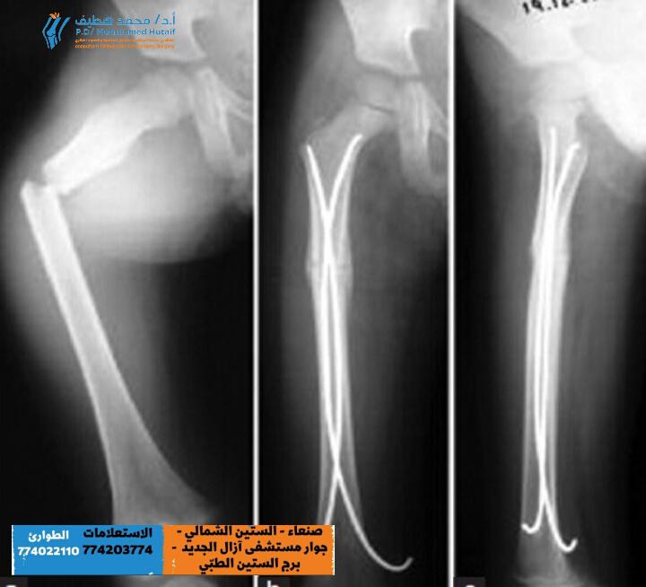  كسور الأطفال