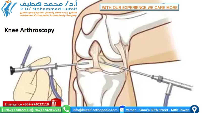 Arthroscopic Knee Surgery: What You Need to Know Now