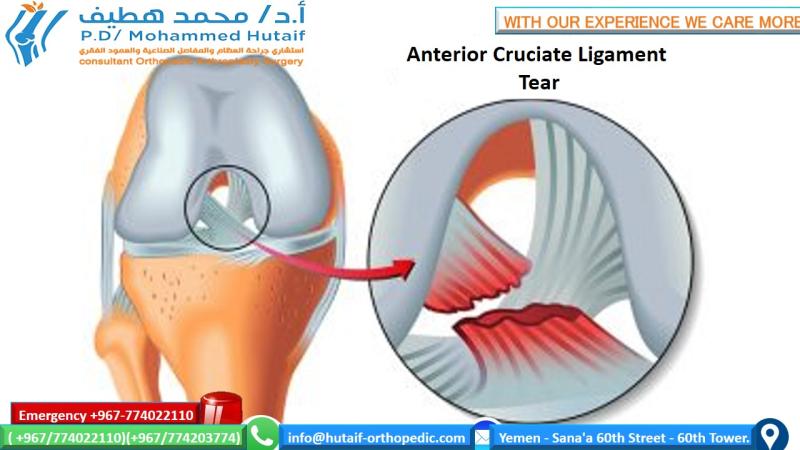 هل يمكنك ثني الركبة مع تمزق الرباط الصليبي الأمامي؟