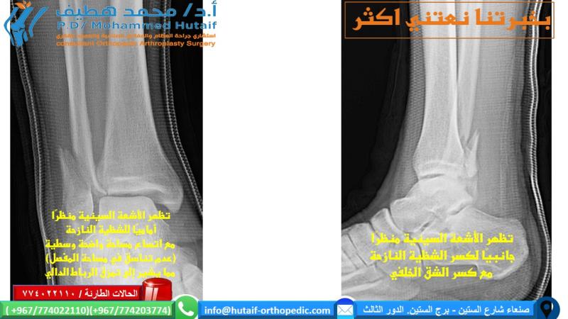 كيف يتم تشخيص كسر الكاحل؟