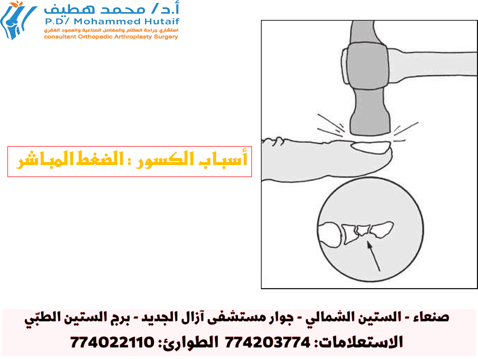 أسباب الكسور