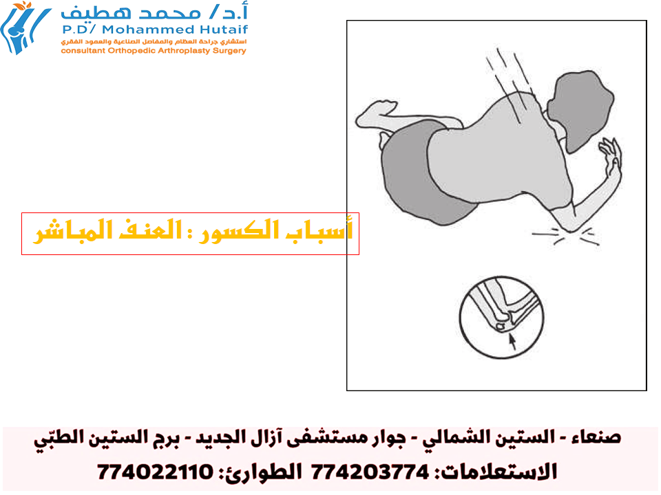 الكسور بالعنف المباشر: كيف تحدث وما هي أسبابها الحقيقية؟