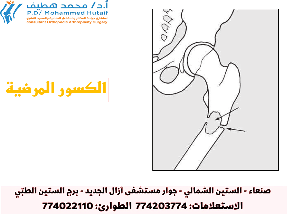 الكسور المرضية