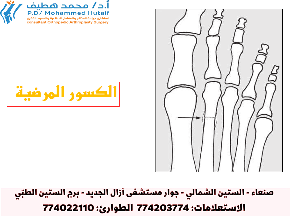 كسور خط الشعر (ج):أنماط الكسور وأهميتها:‏