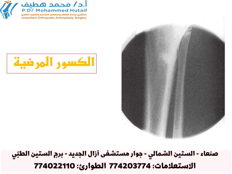 أنماط الكسور وأهميتها:‏ كسور خط الشعر د: